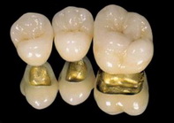 протезирование зубов металлокерамикой